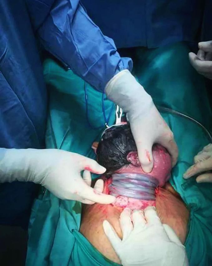 This is an urgent life-saving cesarean section due to nuchal cord!