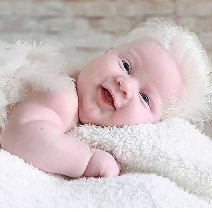Cute Baby born with white hair. I don't know,  but is this waardenburg!?