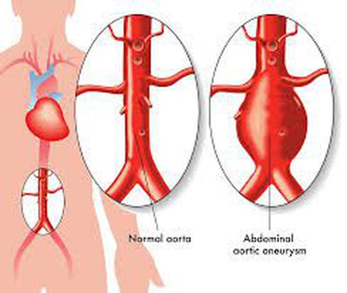 Treatment of abdominal aortic aneurysm