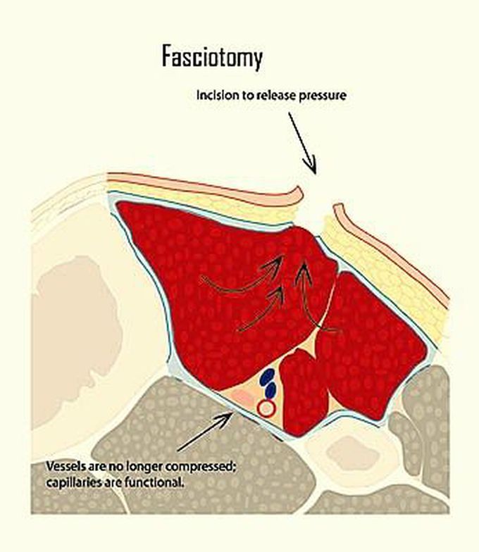 Compartment Syndrome and Fasciotomy