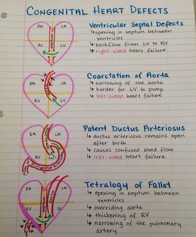 Congenital heart defects