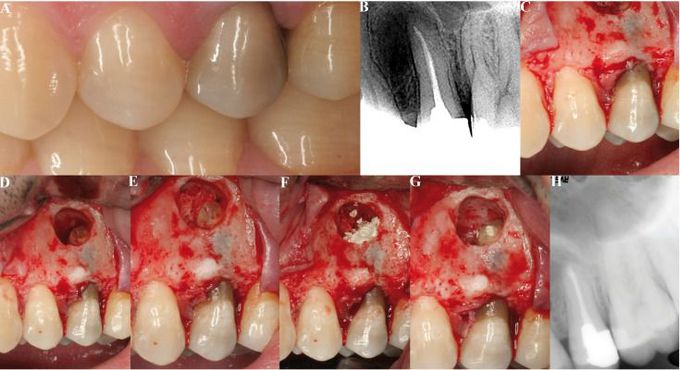 Rationale for periapical surgery