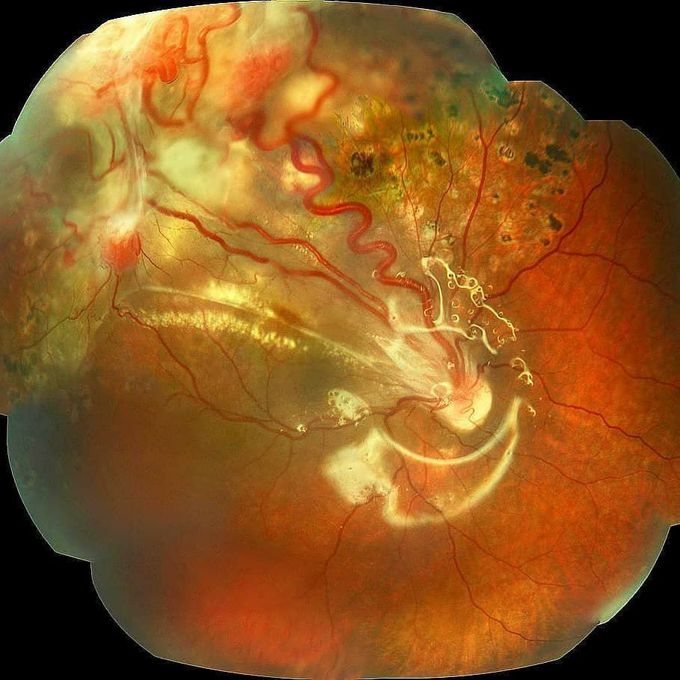 Von hippel lindau syndrome