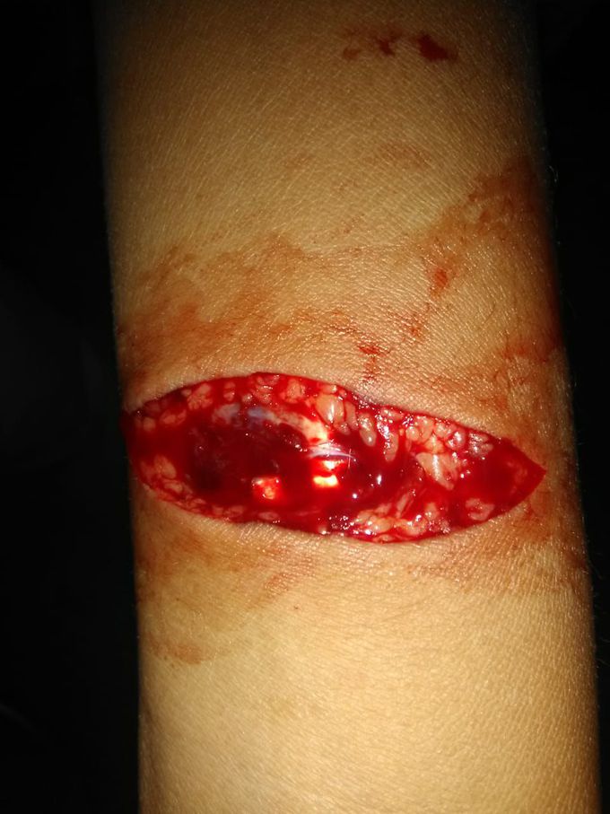 Attempted sucide.....