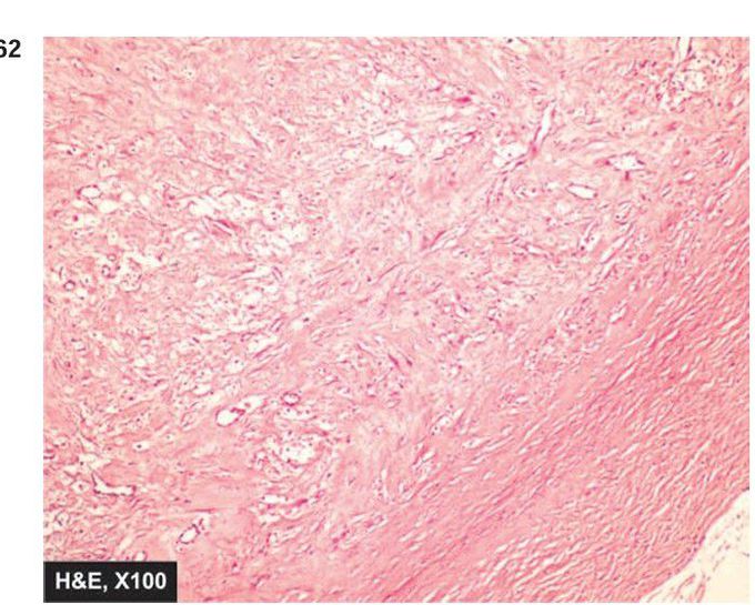 Fibroma of the oral cavity.