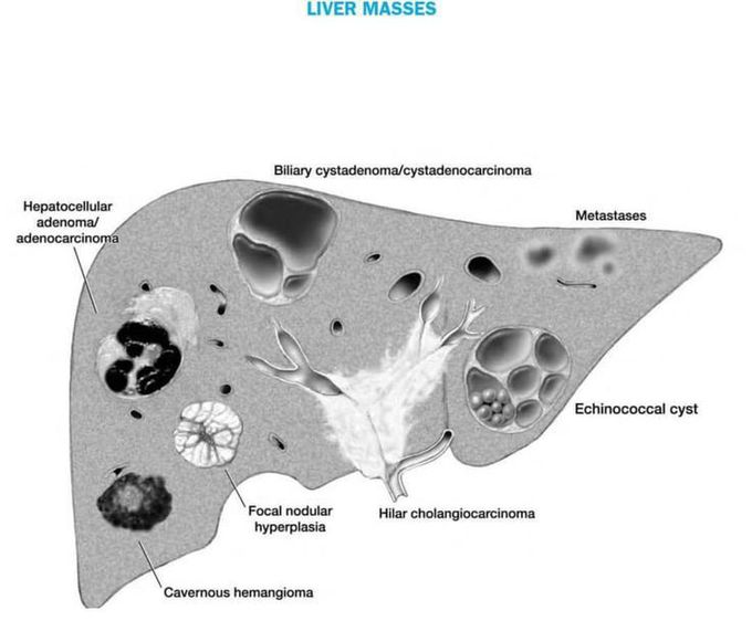 Liver massess
