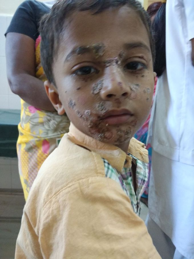 A boy of age 10 with rapid spreading lesions on his face, legs and hand can any one please diagnose this