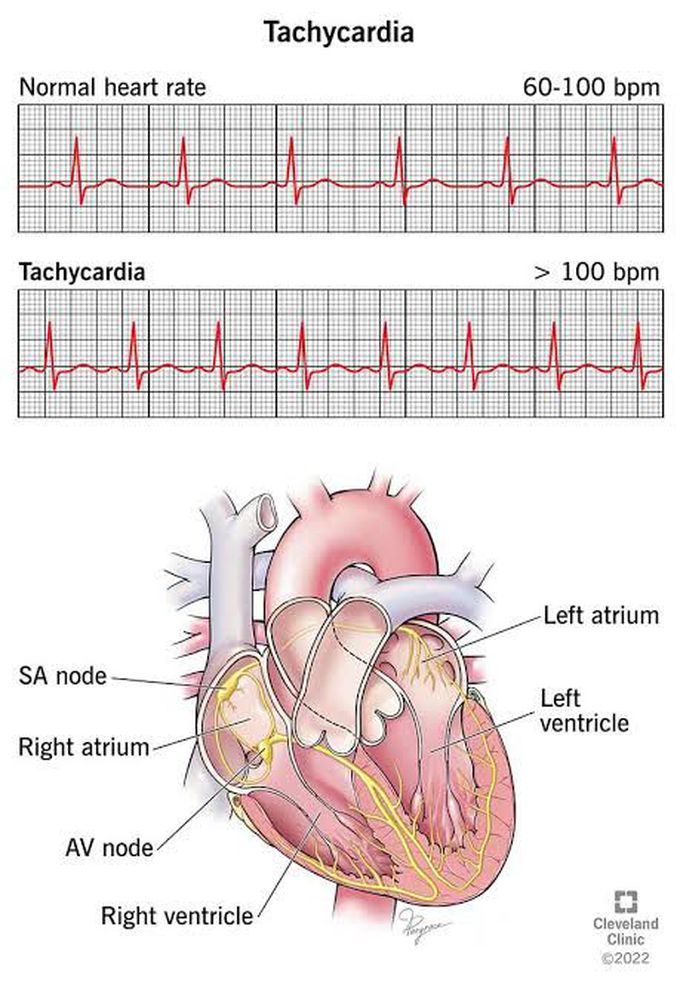 Tachycardia