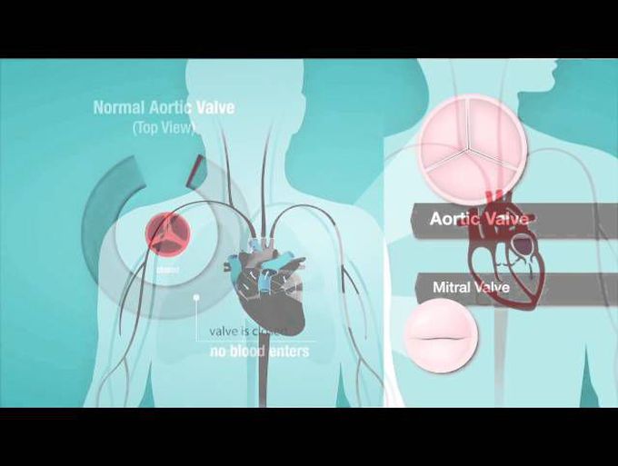 Understanding Heart Murmurs, Aortic and Mitral Valve Problems