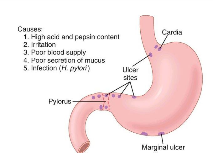 Peptic ulcer sites