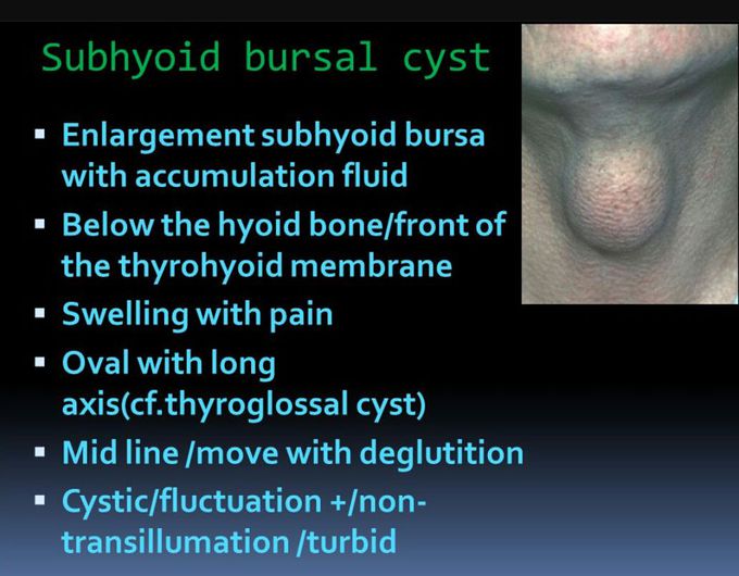 Subhyoid bursal cyst