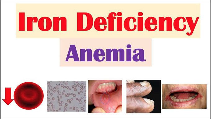 Cause of iron deficiency anemia