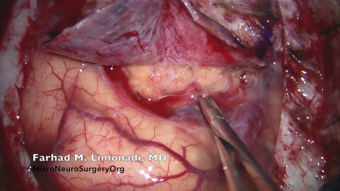 Brain Surgery: Removal of large brain tumor (meningioma)