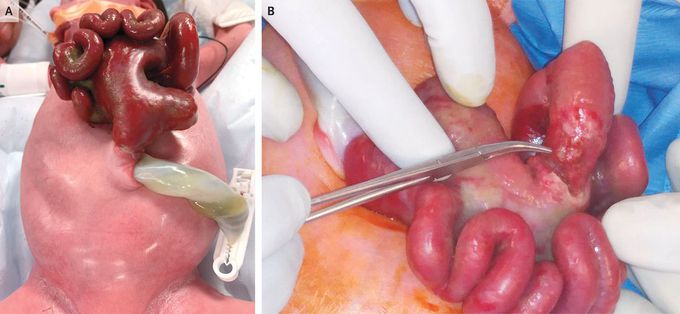 Closed Gastroschisis