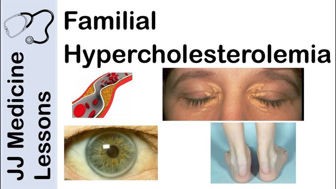 What are the symptoms of hypercholesterolemia?