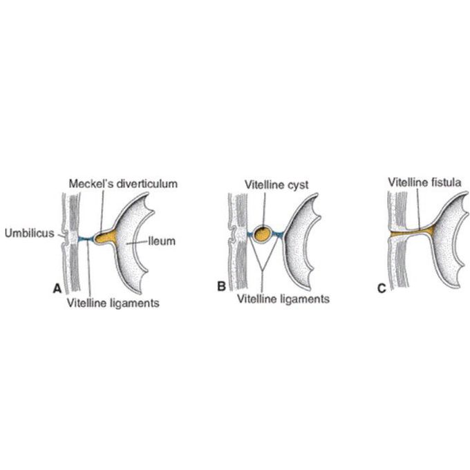 Vitelline duct remnant