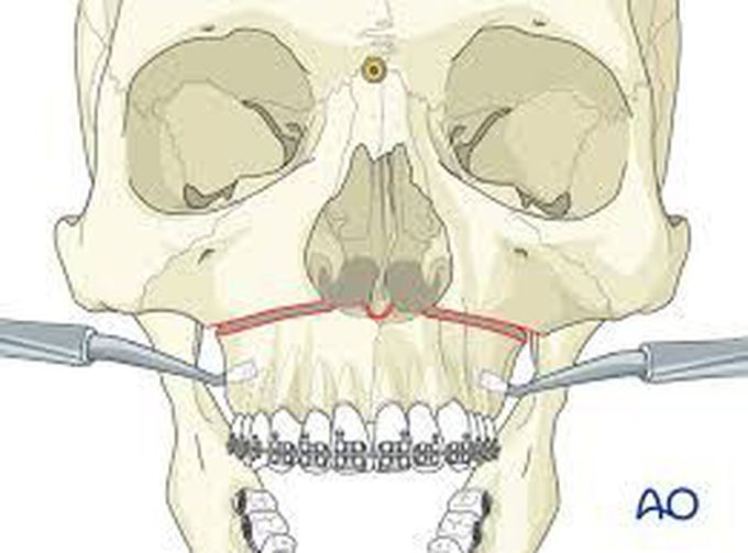 LeFort I Osteotomy