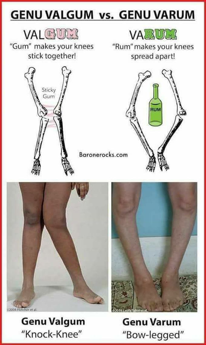 Knee deformities