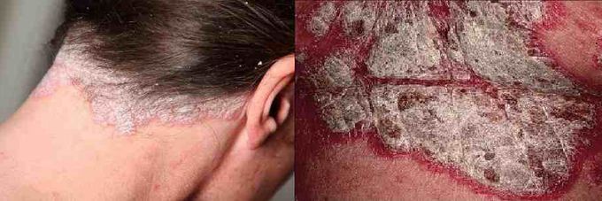 psoriasis