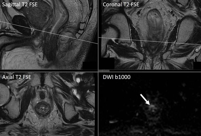 MR Imaging of the rectum