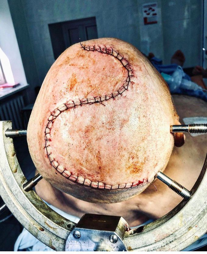 "S" incision