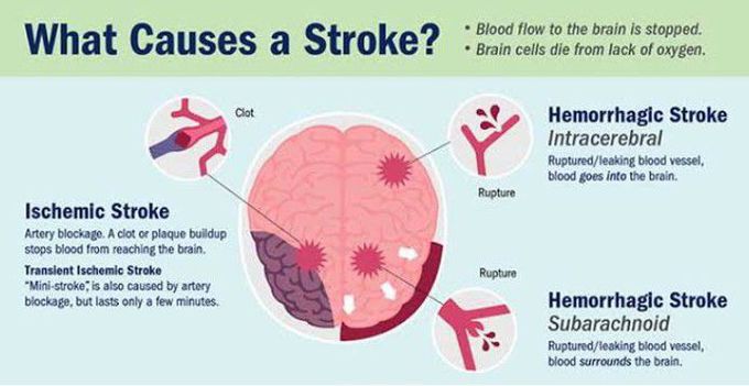 Cause of Stroke