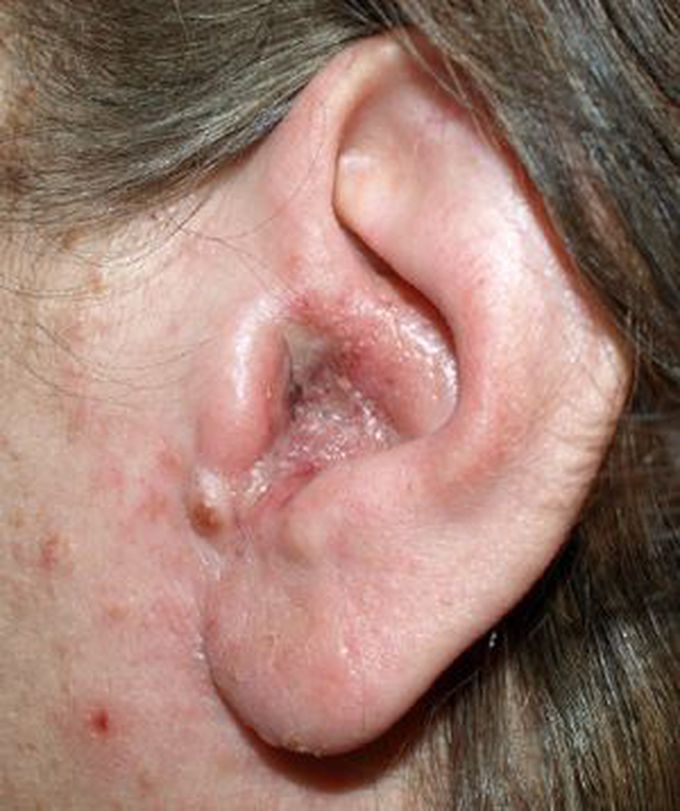 What is otitis externa?