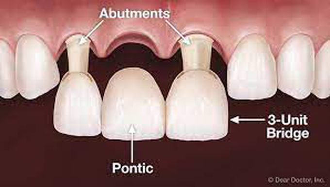 Abutment teeth