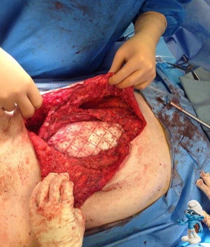 Placement of biological mesh for hernia