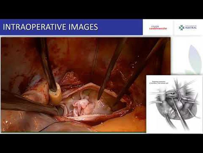 Pulmonary Thromboendarterectomy for Chronic Thromboembolic Pulmonary Hypertension