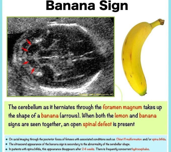 Banana Sign