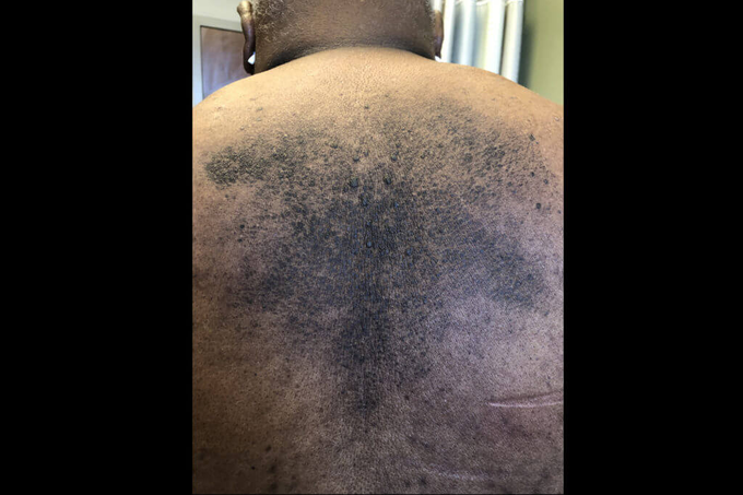 Terra Firma-Forme: Case of Hyperpigmented Plaques on Trunk