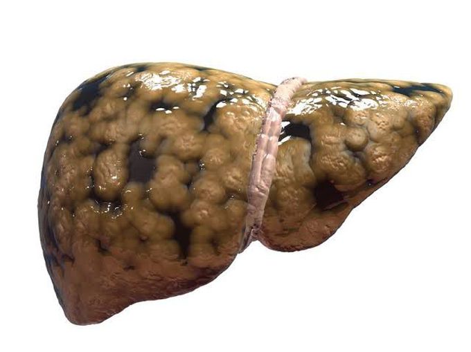 Fatty Liver