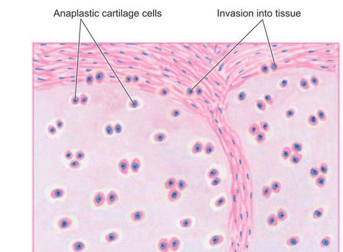 Chondrosarcoma