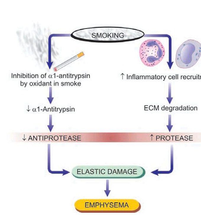 Emphysema