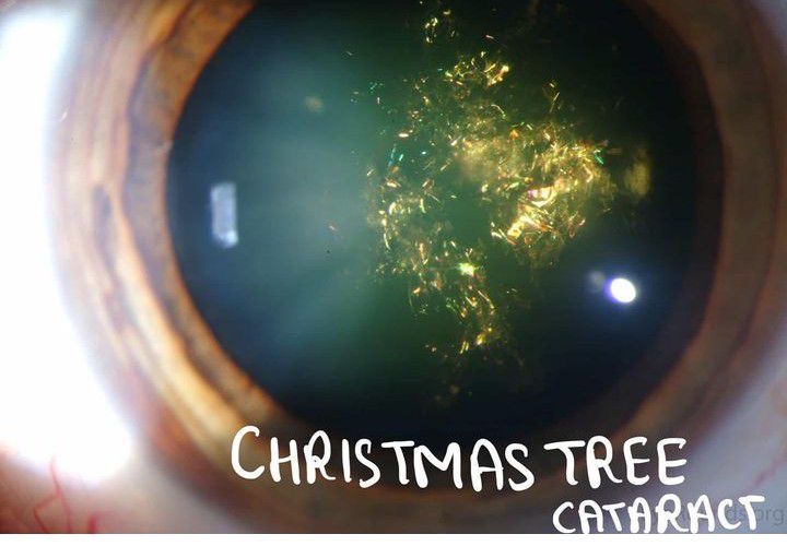 Christmas Tree Cataract MEDizzy