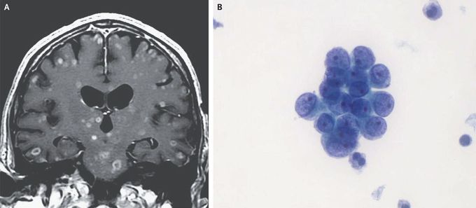 Cerebral Metastases