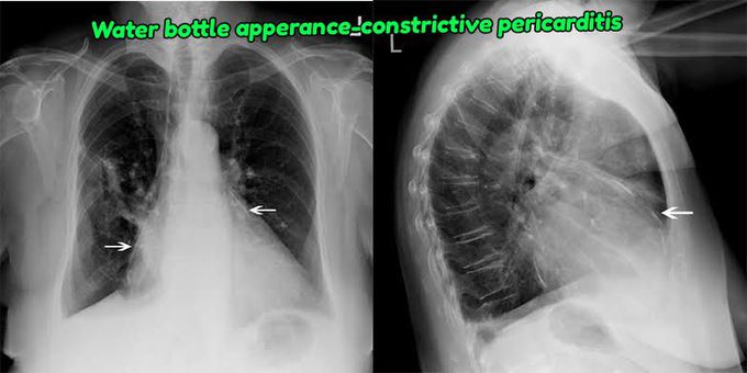 Xray finding of constrictive pericarditis