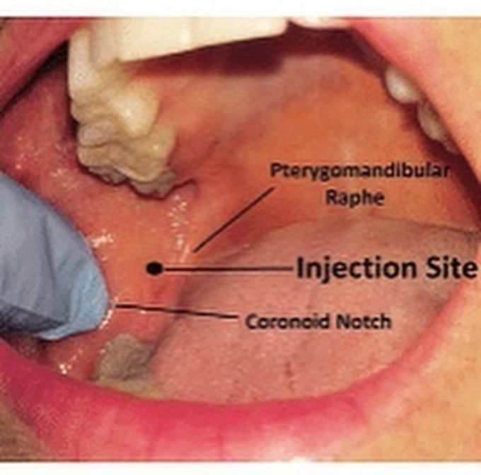 Inferior Nerve Block