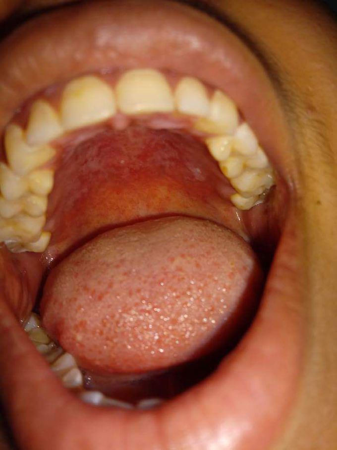 White patches over hard palate

Dx and t/t ?