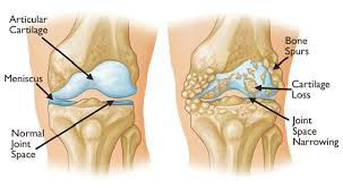 Symptoms of degenerative joint diseases