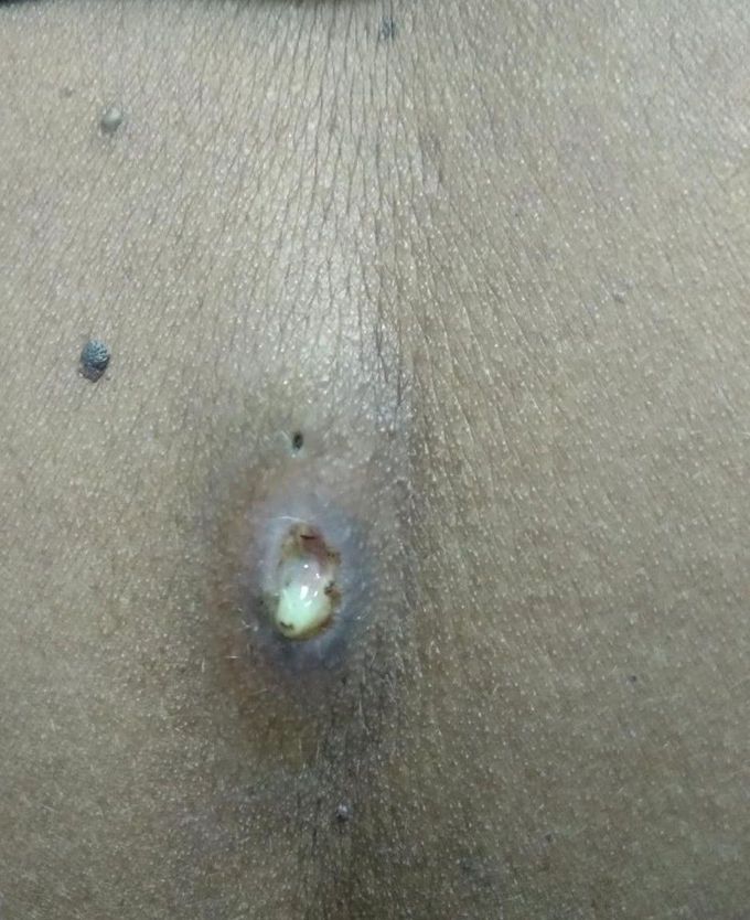 It is present over the spine... what is your diagnosis?