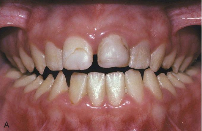 Hypoplastic Amelogenesis Imperfecta, Autosomal Dominant Smooth Pattern (Generalized Thin Pattern).