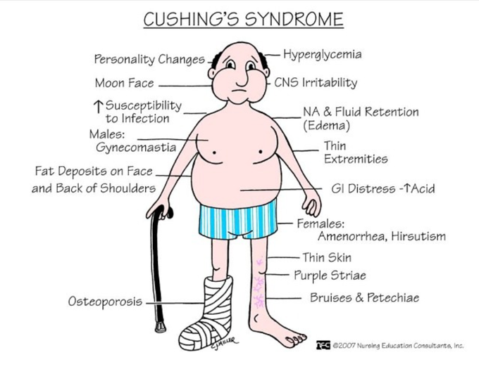 Cushing's syndrome
