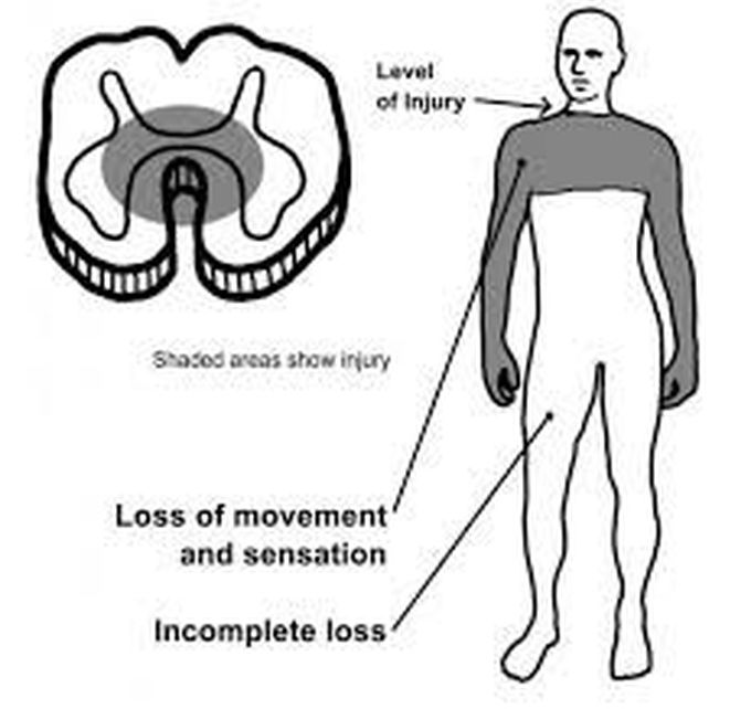 Central cord syndrome