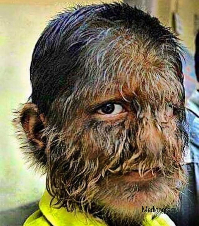 HYPERTRICHOSIS: