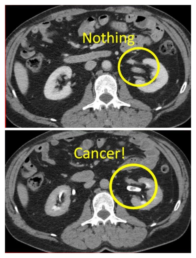 Transitional Cell Carcinoma