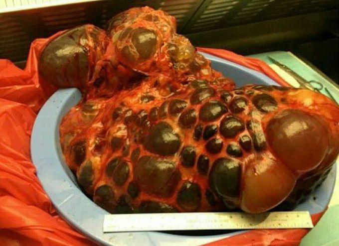 Polycystic kidney disease