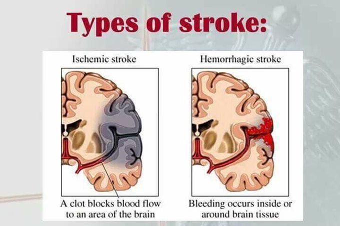Stroke