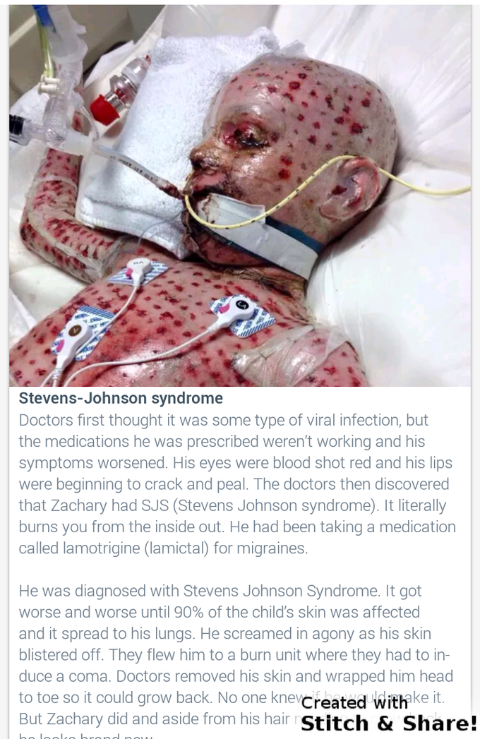 Steven johansob syndrome